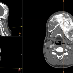 Computed tomography (CT) scan of the head and neck before recent corrective surgery. Polyostotic fibrous dysplasia with invol
