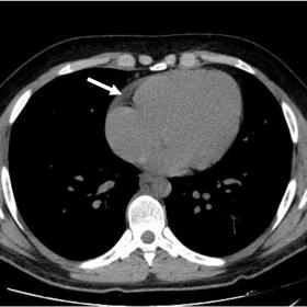 Non-contrast axial thorax CT image shows increased pericardial fluid in the atrioventricular groove (arrow)