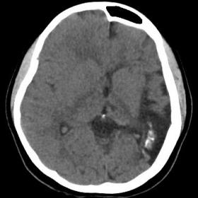 Axial CT Brain showing volume loss of left cerebral hemisphere with gyral atrophy, gyral and cortical calcifications involvin