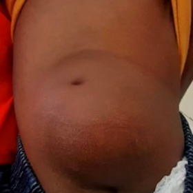 Clinical photograph of the patient showing lump with a small dimple in the lumbosacral region covered by skin