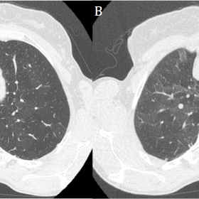 Axial unenhanced high resolution CT slices through the thorax (lung windows) in inspiration (A) and expiration (B). Mosaicism