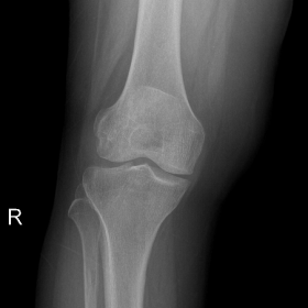 X-Ray right knee shows deep notching of the lateral femoral condyle