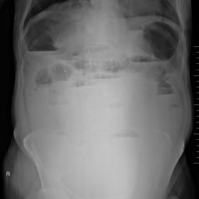 Plain Radiograph of erect abdomen shows multiple air fluid levels