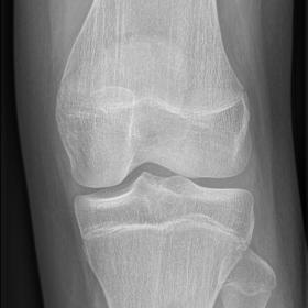 Frontal x-ray of the left knee: subtle hazy radiolucent zone projecting medially over the distal femur metaphysis. Dens corti