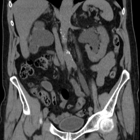 Coronal non-enhanced CT scan: left hydronephrosis  and right renal atrophy