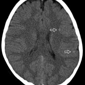 CT without contrast medium, axial (a,c), sagittal (b). Multiple punctate hemorrhagic lesions (arrows) in parietal lobe (a) an