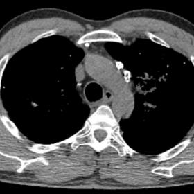 Axial High-resolution CT of thorax, mediastinal window showing multiple hyperdense sub-centimetric randomly arranged pulmonar