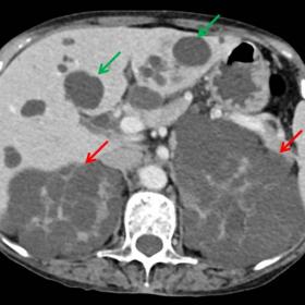 Axial CECT of abdomen in venous phase show multiple cysts in both kidneys (Red arrows) and liver (Green arrows)