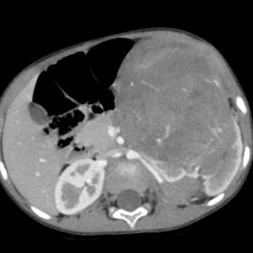 Axial contrast section of CT abdomen showing heterogeneously enhancing mass lesions involving left kidney demonstrating renal