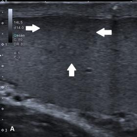 B-mode ultrasound of the left testis demonstrating an almost isoechoic intratesticular lesion with some tine cyst-like areas 