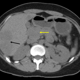 Non enhanced CT image in axial plane showing hypodense lesion in pancreatic head and uncinate process (Yellow arrow) and hypo