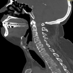 Shows multiple lesions involving vertebral bodies. Absence of sclerotic halo around lesions diffrentiates lytic metasasis fro