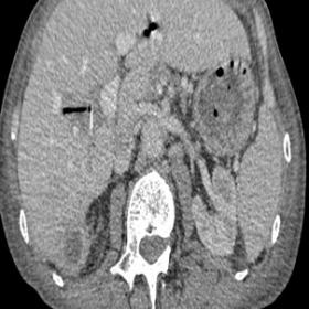 Axial and reconstructed coronal CT images showing the plastic stent coursing perpendicular to the intrahepatic duct and poste