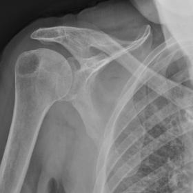 AP radiograph of the shoulder demonstrating a large lytic lesion within the greater tuberosity of the right proximal humerus