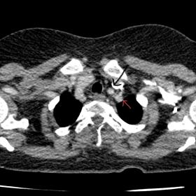 Axial contrast CT at thoracic inlet shows a contrast filled accessory vessel (red arrow) at the left visceral mediastinum sep