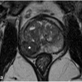 MRI (T2W images on axial, coronal and sagittal planes): a well-defined lesion is seen on the right posterior PZ (star), exten
