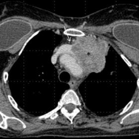 Axial contrast-enhanced chest CT shows a bulky mass invading the left part of the anterior mediastinum (asterixis), encasing 