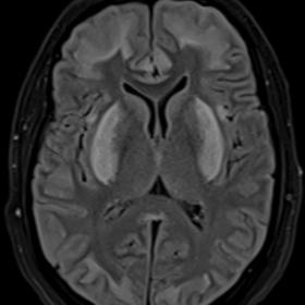 FLAIR axial sequence showing symmetric hyperintensity in bilateral lentiform nucleus, subcortical white matter in bilateral f