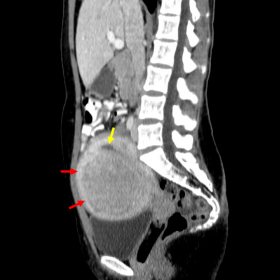 Sagittal (a) and axial (b) images of a contrast-enhanced CT showing an enhancing uterine mass, slightly heterogeneous, surrou