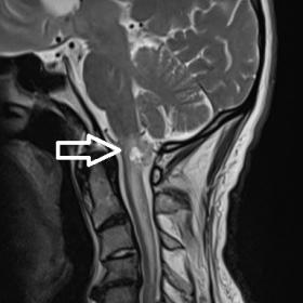 Sagittal T2-WI: Note an intra-axial lesion of heterogenous signal intensity within the medulla oblongata (arrows). There is e