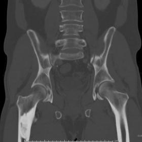 Coronal CT demonstrates sclerotic intramedullary abnormality within the right proximal femur. There was no associated cortico