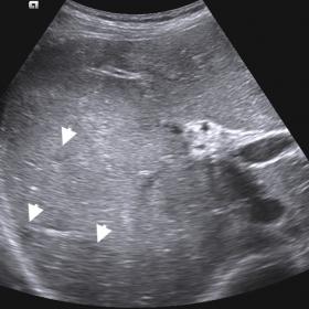Gray-scale US image of the liver demonstrates heterogeneous echotexture in the liver parenchyma with ill-defined hypoechoic a