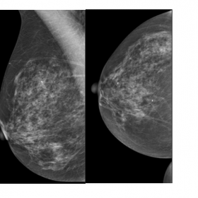 Mammogram of the right breast  shows BIRADS density C and appears normal BIRDAS 1