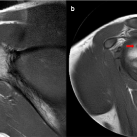 T1 coronal (a) and sagittal (b) images show focal defect involving the articular surface of the humeral head (red arrows).
