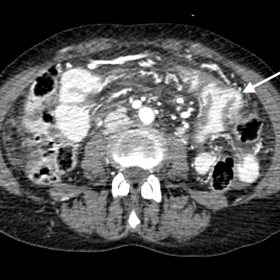 Dual bolus axial CT shows a transected proximal small bowel loop, demonstrating hyperenhancement, oedema and folding back of 