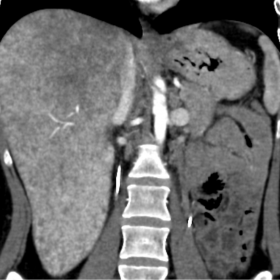 Coronal contrast-enhanced CT image showed hepatomegaly with heterogeneous parenchymal enhancement.