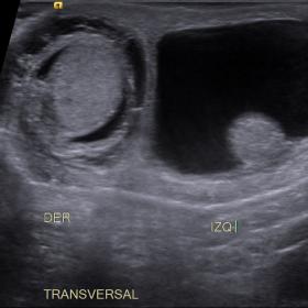Ultrasound. Right testicle with hypoechoic ring with the presence of septa around it. Left hydrocele.