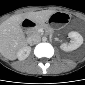 Axial nephrographic phase CT image showing lobulated cystic structure surrounding the left kidney in the perinephric region. 