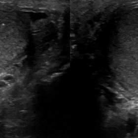 Composite image of two transverse testicular ultrasound views show enlargement of the right testicle (on the right)
