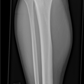 AP radiograph of the tibia and fibula with no radiographic abnormality