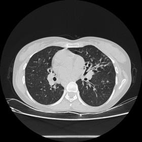 On HRCT thorax Axial section, bronchiectatic changes in form of  cystic and varicoid bronchiectasis with bronchial wall thick