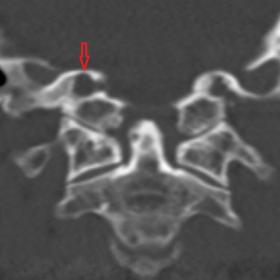 Coronal bone window CT image shows a widening of the right hypoglossal canal.