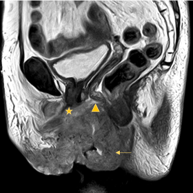 Sagittal T2-weighted (a) and axial T2-weighted images (b, c) show a large tumour (arrow) in the vulva, with intermediate sign