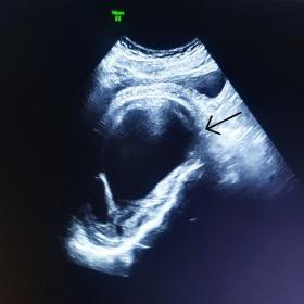 Pelvis ultrasonography shows a thick walled cystic lesion with thin internal septations seen in in presacral region displacin