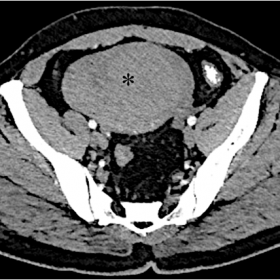 Axial contrast-enhanced CT showing a large heterogeneously enhancing lesion (asterisk) in the midline of the pelvis
