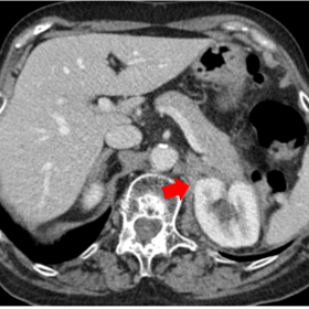 Axial contrast enhanced CT image shows infiltrative solid lesions on the left perirenal space (arrow).
