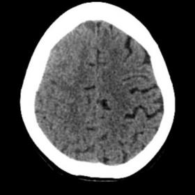 CT head shows sulcal effacement at the right superior cerebral hemisphere