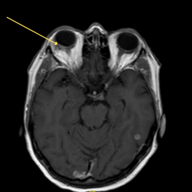 Post-contrast axial T1- weighted image demonstrates a well-defined enhancing semilunar lesion at the right posterior globe. I