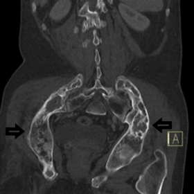 Coronal reconstructed CT image (bone window) demonstrating bone expansion, cystic changes and ground glass matrix of the pelv