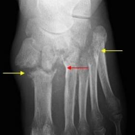 Left Foot AP (A) and Oblique (B) radiographic views showing articular bony erosions/ destruction (yellow arrows) and joint di