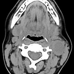 Axial image from neck CT obtained prior to contrast administration depicts a nodular lesion in lymph node level II (white arr