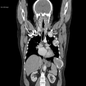 Coronal soft tissue window CT scan image of the thorax showed expansive lesions with ground glass matrix and cystic changes i