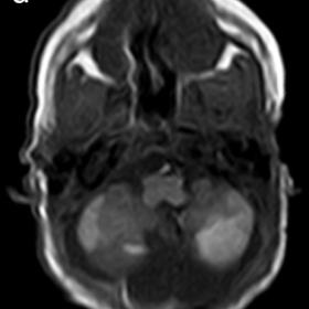Axial cranial MRI on T1-weighted images without contrast showing hyperintense foci without mass effect located in the cerebel