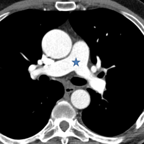 Axial Chest CTA, mediastinal window, at the level of the pulmonary arteries (a) showing normal opacification (blue star), wit