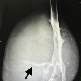 Frontal radiograph of the left knee and distal thigh depicting sizeable soft tissue lesion causing widespread destruction of 