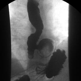 Fluoroscopy image of barium swallow study shows that the barium appears diluted inside the diverticulum, which indicates that